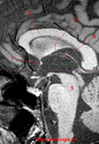 comisuraanterior.jpg