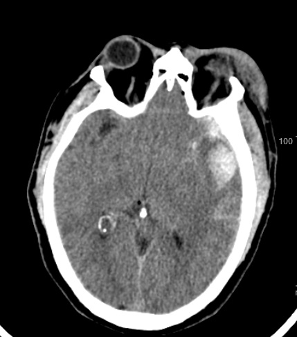 contusioncerebralq5480.jpg