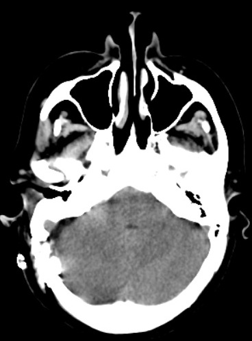 descompresionmicrovasculartacpostoperatorio.jpg