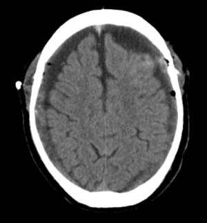 hematomasubduralcronicotacpostq5436.jpg
