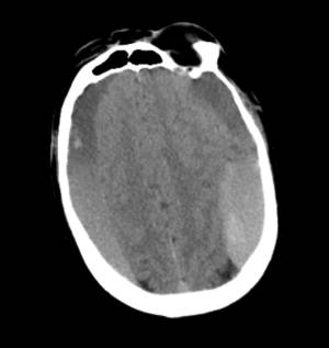 hematomasubduralcronicotacq5436.jpg