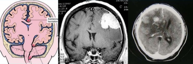 herniacionsubfalcina.jpg