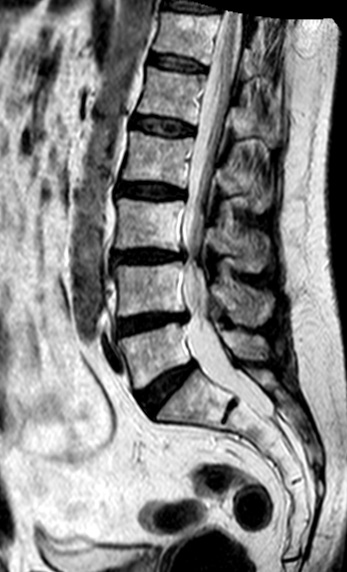 herniadiscallumbarl3l4i7414.jpg