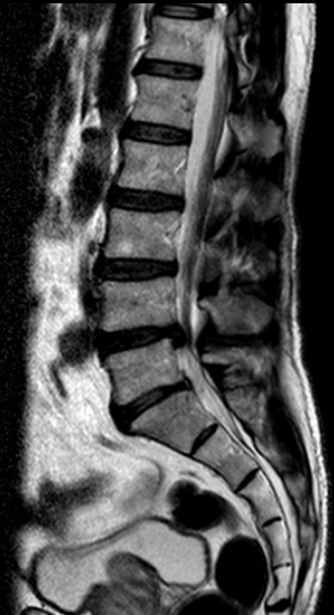 herniadiscallumbarl4l5q5481.jpg
